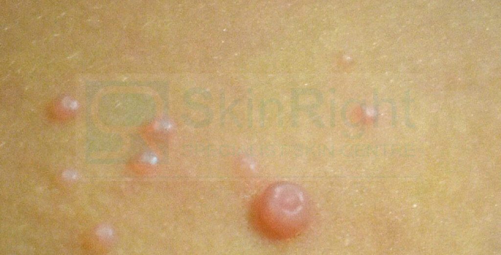 Molluscum contagiosum - 香港皮膚科醫生 - SkinRight Skin Surgery and Laser ...