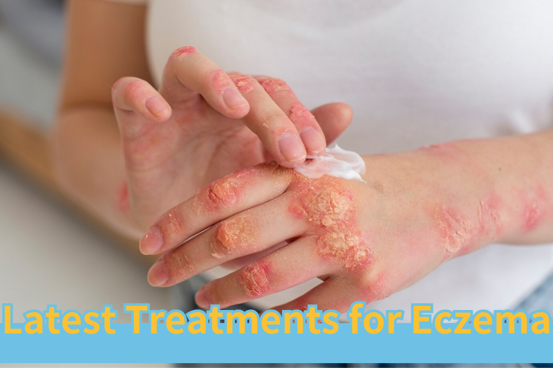 Read more about the article Can this be used to treat eczema without steroids?