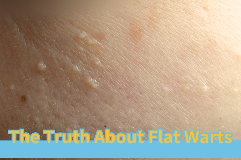 Read more about the article The Truth About Flat Warts