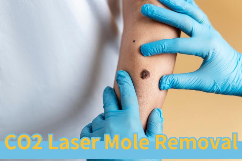 Read more about the article CO2 Laser Mole Removal