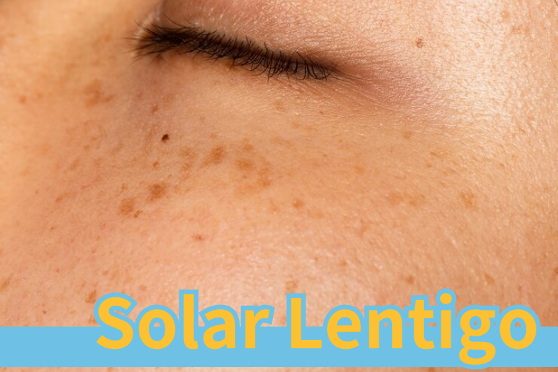 Read more about the article How to Combat Solar Lentigo?