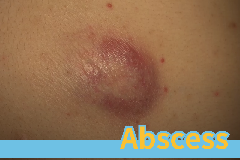 Read more about the article Symptoms, Diagnosis, and Treatment of Abscesses