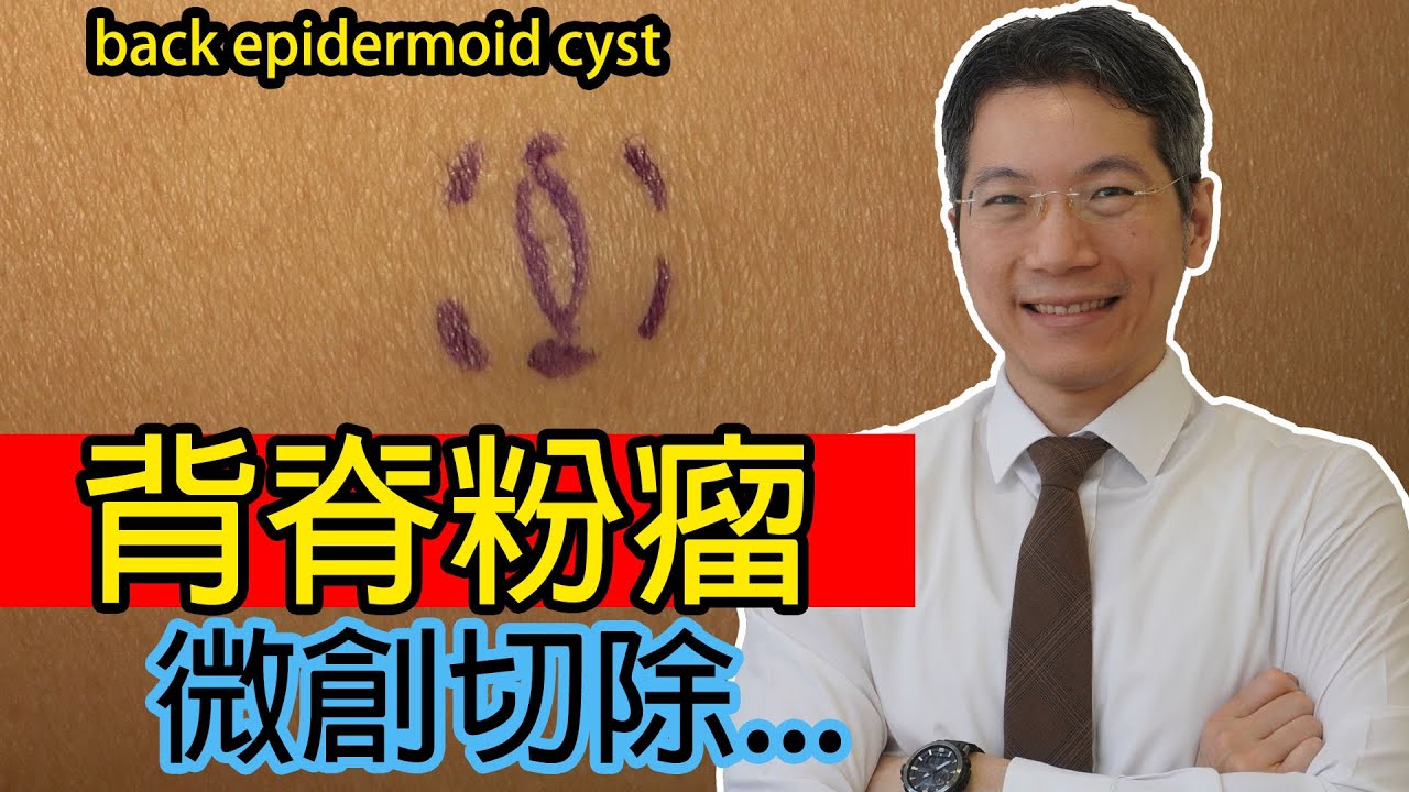 Read more about the article 背脊粉瘤微創切除