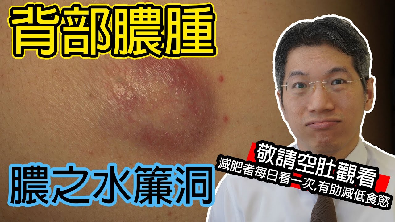 Read more about the article 背部膿腫 膿之水簾洞