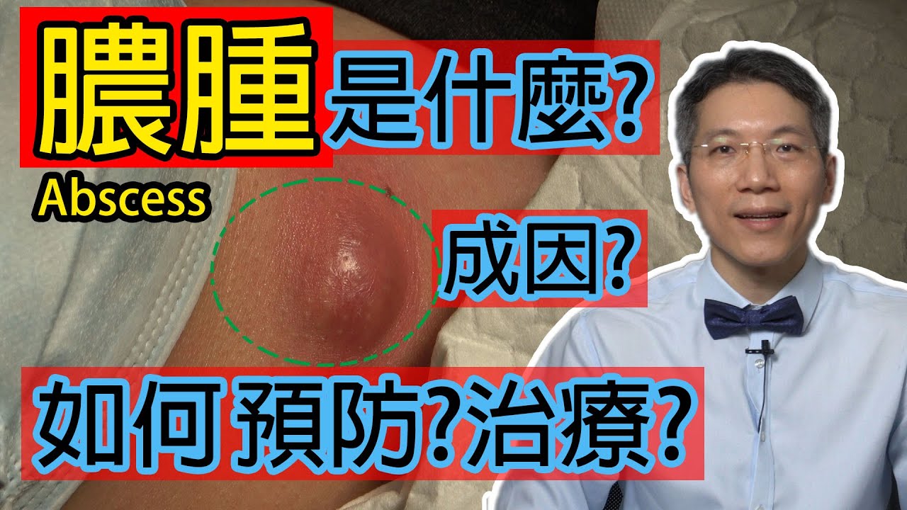 Read more about the article 膿腫是什麼