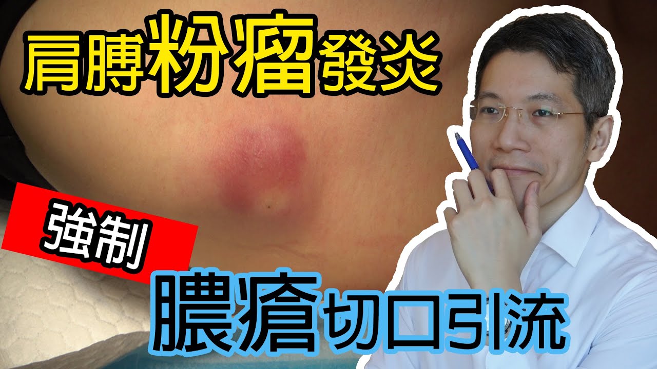 Read more about the article 肩膊粉瘤發炎 強制膿瘡切口引流