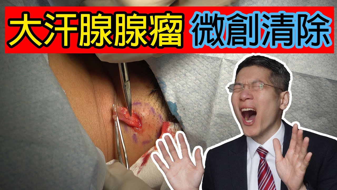 Read more about the article 大汗腺腺瘤微創清除