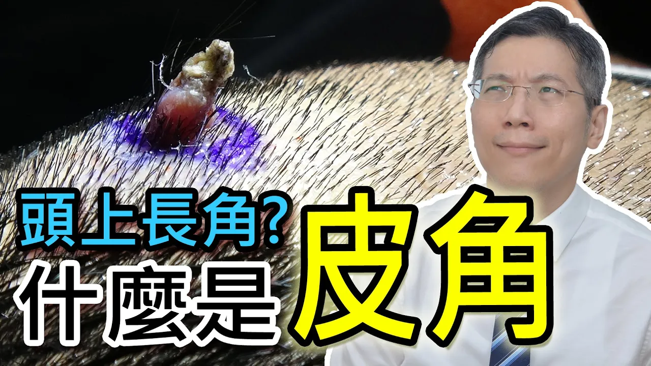 Read more about the article 頭上長角？什麽是皮角？