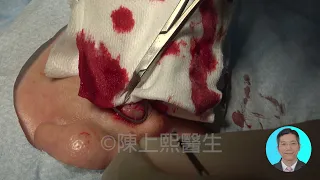 化膿性肉芽腫？嘴唇腫瘤？孖生腫瘤？到底是什麼東西