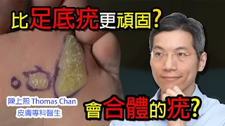 頑固足底疣 不斷擴張