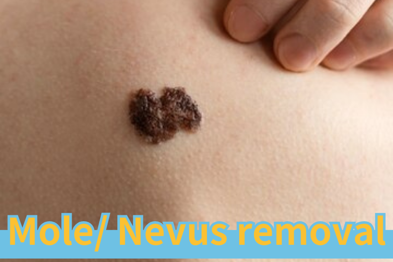 Read more about the article How Much Do You Know About Removing Moles?