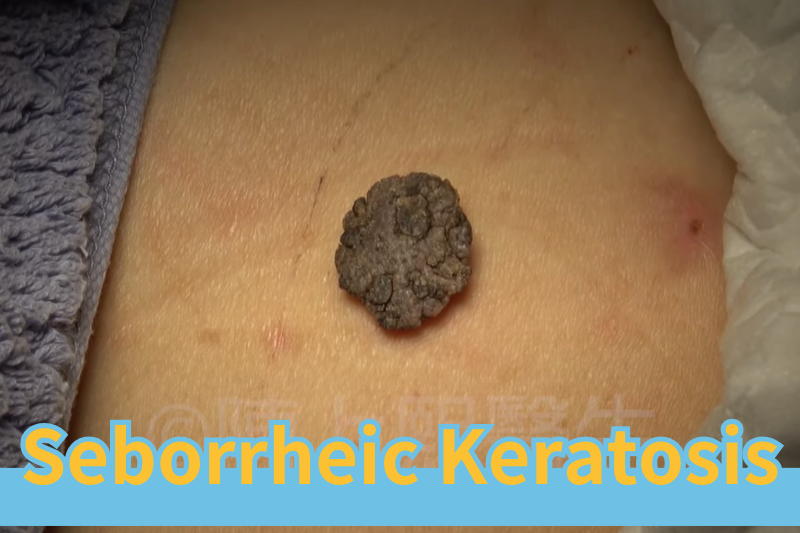 Read more about the article Seborrheic Keratosis: A Comprehensive Guide from Diagnosis to Treatment