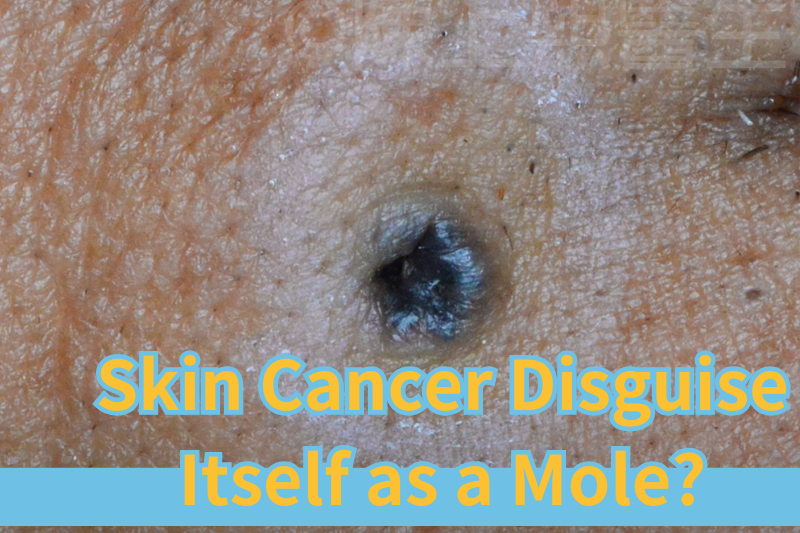 Read more about the article Skin Cancer Disguised as a Mole? Doctor Teaches You How to Identify It at a Glance!