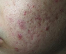 skin-problem-暗瘡-img-22-2x