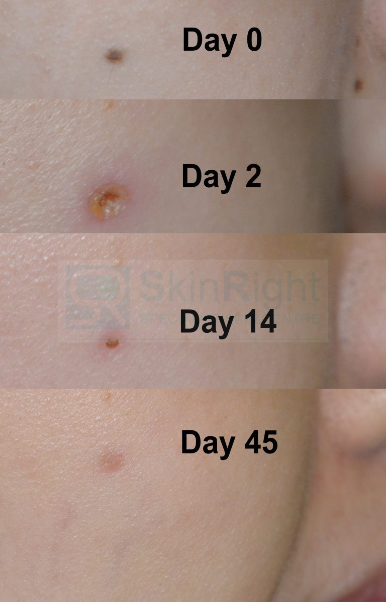 Naevus/Mole removal SkinRight 陳上熙醫生 皮膚專科 皮膚科 Chan